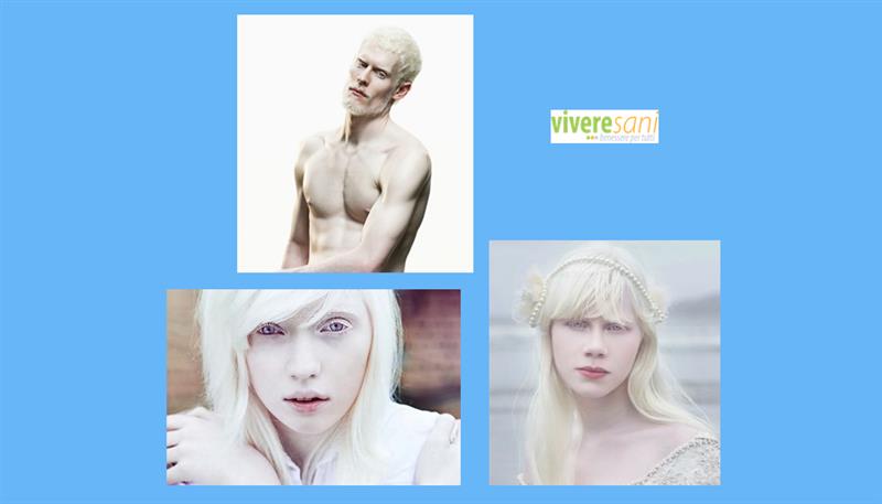 Sfumature di bianco: l'albinismo